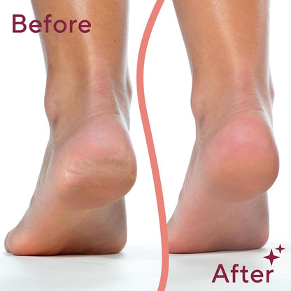 Electric Callus Remover for Feet, Two Colors, view 6